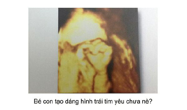 Ngắm loạt ảnh thai nhi tạo dáng đáng yêu không thể tả 56 Ngắm loạt ảnh thai nhi tạo dáng đáng yêu không thể tả 28