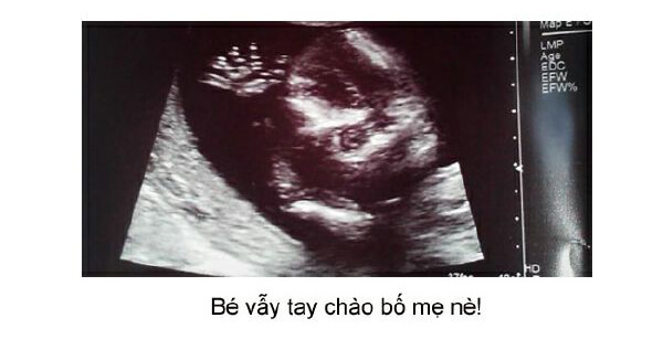 Ngắm loạt ảnh thai nhi tạo dáng đáng yêu không thể tả 53 Ngắm loạt ảnh thai nhi tạo dáng đáng yêu không thể tả 25
