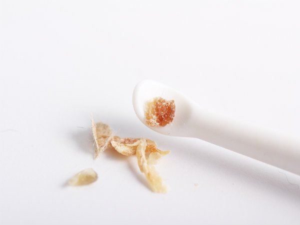 Nhìn màu ráy tai, đoán “trúng phóc” bệnh bạn đang mắc phải 34 Nhìn màu ráy tai, đoán “trúng phóc” bệnh bạn đang mắc phải 6