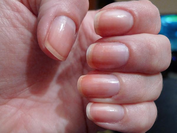 Nhìn móng tay đoán được 10 bệnh hiểm nghèo 41 Nhìn móng tay đoán được 10 bệnh hiểm nghèo 13