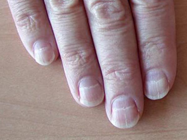 Nhìn móng tay đoán được 10 bệnh hiểm nghèo 42 Nhìn móng tay đoán được 10 bệnh hiểm nghèo 14