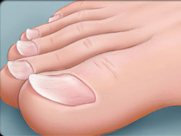 Nhìn móng tay đoán được 10 bệnh hiểm nghèo 46 Nhìn móng tay đoán được 10 bệnh hiểm nghèo 18