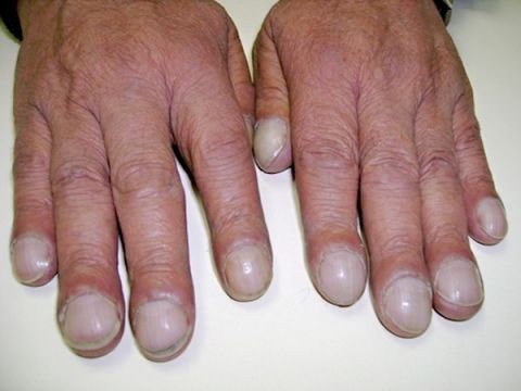 Nhìn móng tay đoán được 10 bệnh hiểm nghèo 47 Nhìn móng tay đoán được 10 bệnh hiểm nghèo 19