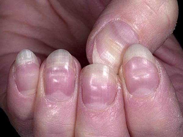 Nhìn móng tay đoán được 10 bệnh hiểm nghèo 48 Nhìn móng tay đoán được 10 bệnh hiểm nghèo 20
