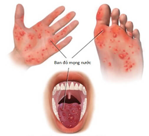Những căn bệnh ở trẻ nhỏ, người lớn cũng có thể bị lây nhiễm 35 Những căn bệnh ở trẻ nhỏ, người lớn cũng có thể bị lây nhiễm 7