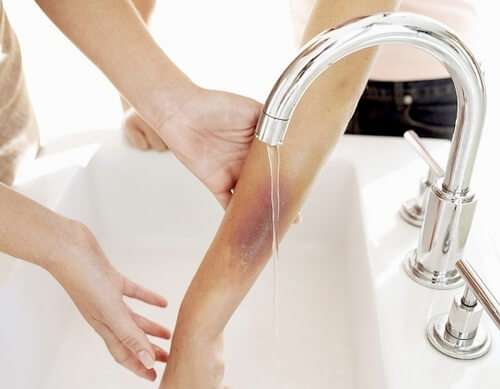 Những điều cần làm ngay khi con bị bỏng 6