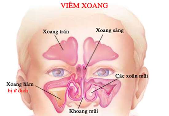 Những điều nguy hiểm mẹ nên biết về viêm xoang ở trẻ em 36 viêm xoang trẻ em