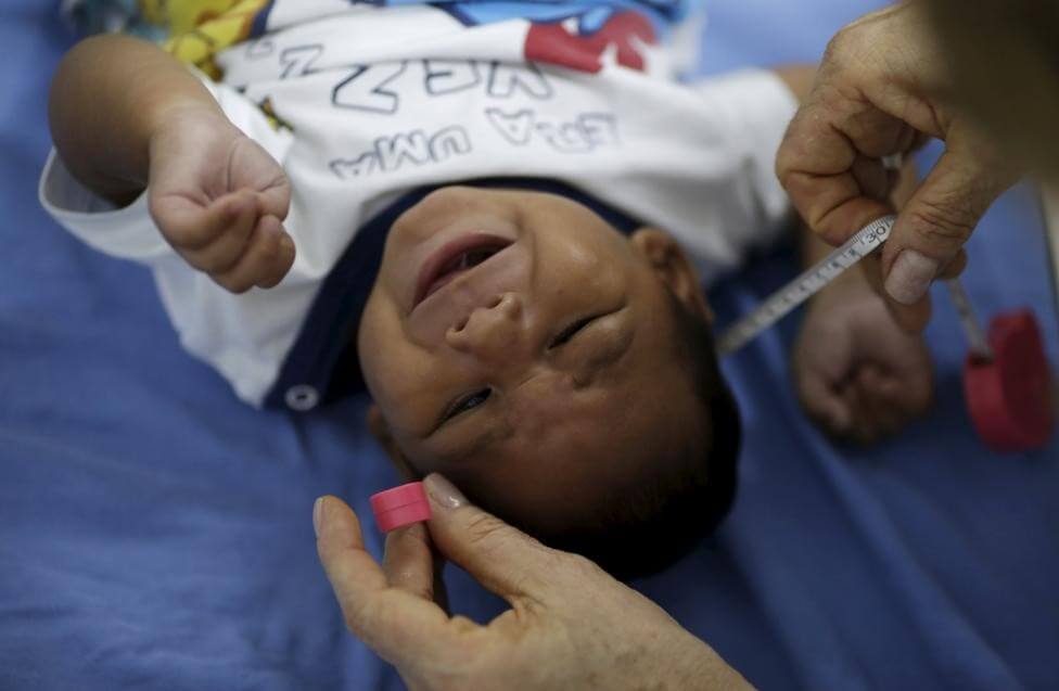 Những khuôn mặt trẻ thơ bị nhiễm virus Zika gây ám ảnh người nhìn 61 Những khuôn mặt trẻ thơ bị nhiễm virus Zika gây ám ảnh người nhìn 33