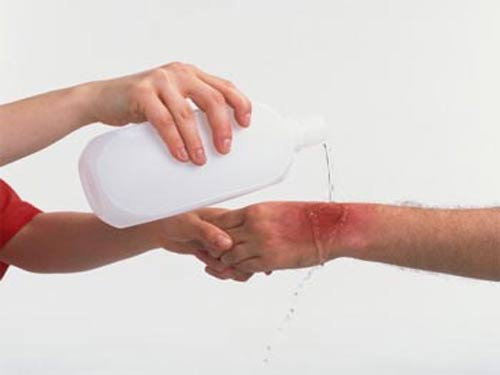 Phân loại phỏng và cách sơ cứu khi bé bị phỏng 35 Phân loại phỏng và cách sơ cứu khi bé bị phỏng 7
