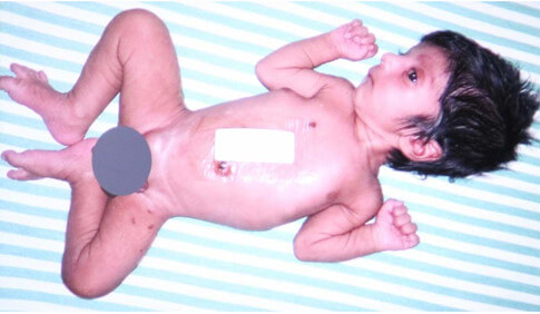 Phẫu thuật cứu sống bé trai có 4 chân, 2 cơ quan sinh dục 36 Phẫu thuật cứu sống bé trai có 4 chân, 2 cơ quan sinh dục 8