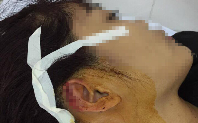 Phụ huynh cắn đứt tai giáo viên vì bức xúc cách dạy con 37 Phụ huynh cắn đứt tai giáo viên vì bức xúc cách dạy con 9