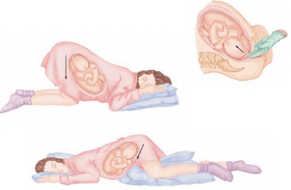 Sa dây rốn: Cụm từ ám ảnh mẹ bầu! 36 Sa dây rốn: Cụm từ ám ảnh mẹ bầu! 8