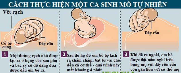 Sinh mổ tự nhiên - Những điều mẹ cần biết! 34 Sinh mổ tự nhiên - Những điều mẹ cần biết! 7