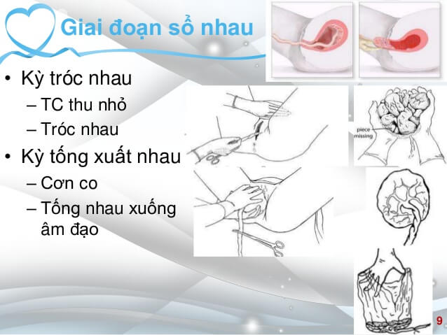 Sổ nhau thai, giai đoạn cuối cùng của quá trình sinh con 8