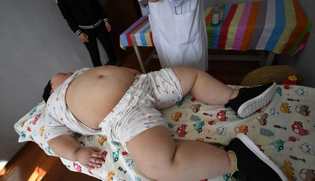 Sốc nặng vì bé gái 75kg, mỗi tháng lại tăng thêm 10kg 39 Sốc nặng vì bé gái 75kg, mỗi tháng lại tăng thêm 10kg 11