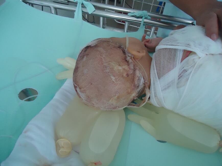 Tai nạn bỏng ở trẻ nhỏ, nỗi đau khó có thể chữa lành 33 Tai nạn bỏng ở trẻ nhỏ, nỗi đau khó có thể chữa lành 5
