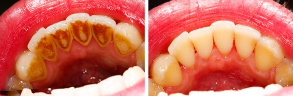 Tặng bạn bí quyết cho hàm răng trắng sáng và hơi thở thơm mát 33 Tặng bạn bí quyết cho hàm răng trắng sáng và hơi thở thơm mát 5
