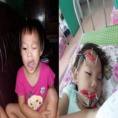 Thói quen tưởng như vô hại của mẹ lại khiến con bị méo miệng, liệt mặt 38 Thói quen tưởng như vô hại của mẹ lại khiến con bị méo miệng, liệt mặt 10
