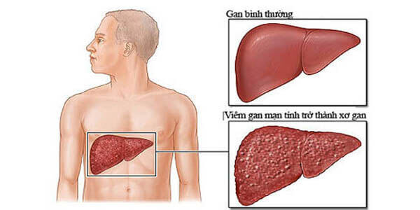 Thức uống giải độc gan thần kỳ cho người hay uống rượu 5