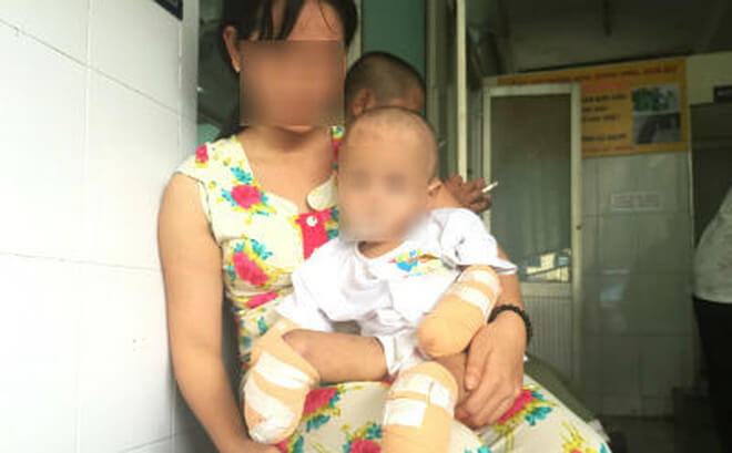 Tiền Giang: Viêm màng não mô cầu, bé 2 tuổi buộc phải đoạn chi 34 Tiền Giang: Viêm màng não mô cầu, bé 2 tuổi buộc phải đoạn chi 6