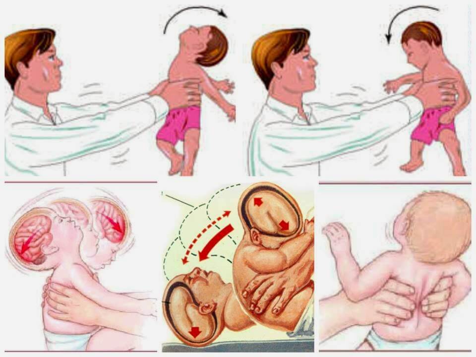 Trẻ có thể chảy máu não, dập não và chậm phát triển nếu thường xuyên bị tung hứng 34 Trẻ có thể chảy máu não, dập não và chậm phát triển nếu thường xuyên bị tung hứng 6