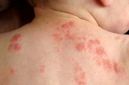 Trẻ thường xuyên đi bơi tiềm ẩn nguy cơ bị 7 căn bệnh đáng ngại này 37 di-ung