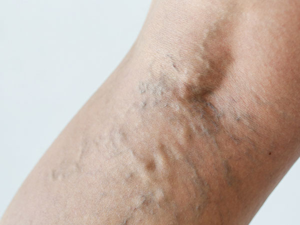 Trị dứt giãn tĩnh mạch bằng cà chua xanh 34 suy giãn tĩnh mạch