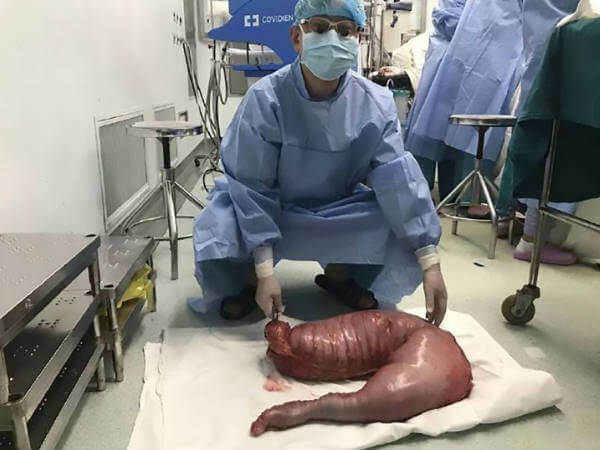 Trung Quốc: Một người đàn ông mang khối ruột thừa nặng 13kg 33 Trung Quốc: Một người đàn ông mang khối ruột thừa nặng 13kg 5
