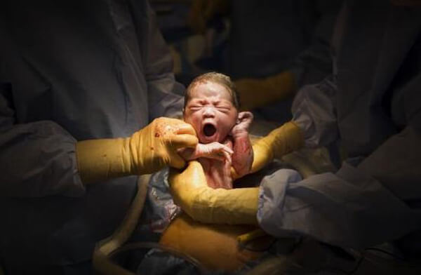 Tuyệt đẹp khoảnh khắc bé yêu rời khỏi bụng mẹ 44 mo