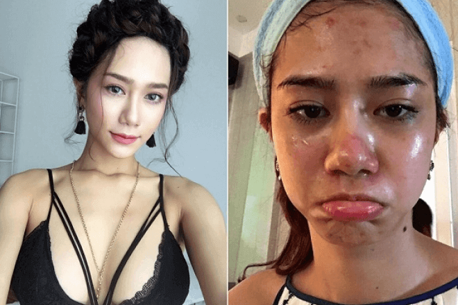Ưu, nhược điểm của việc làm đẹp bằng phương pháp lăn kim 36 Ưu, nhược điểm của việc làm đẹp bằng phương pháp lăn kim 8
