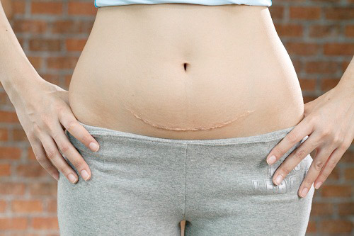 Vết sẹo mổ đẻ, dấu ấn thiêng liêng của hành trình làm mẹ 6