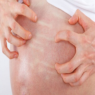 Xua tan chứng ngứa ngáy khó chịu khi mang thai 7