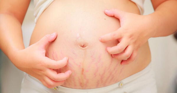 Xua tan chứng ngứa ngáy khó chịu khi mang thai 8
