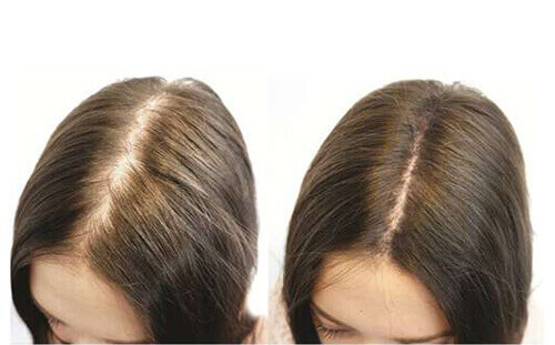 1.001 tuyệt chiêu trị rụng tóc tại nhà hiệu quả bất ngờ 34 1.001 tuyệt chiêu trị rụng tóc tại nhà hiệu quả bất ngờ 6