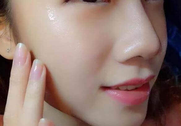 trị lỗ ch&acirc;n l&ocirc;ng to bằng phương ph&aacute;p tự nhi&ecirc;n