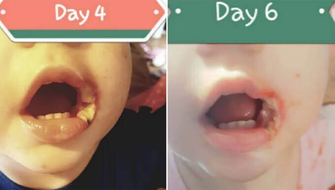 Bé bị bỏng miệng vì mẹ quên rút sạc điện thoại di động 33 Bé bị bỏng miệng vì mẹ quên rút sạc điện thoại di động 5