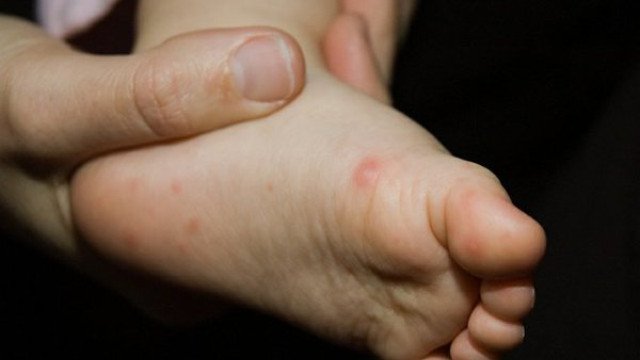 Bé bị tay chân miệng phải làm sao để nhanh khỏi bệnh 6
