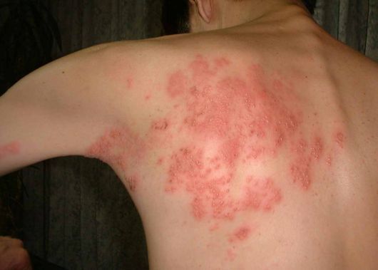 Cách chữa bệnh giời leo bằng đậu xanh nhanh và an toàn 35 Cách chữa bệnh giời leo bằng đậu xanh nhanh và an toàn 7