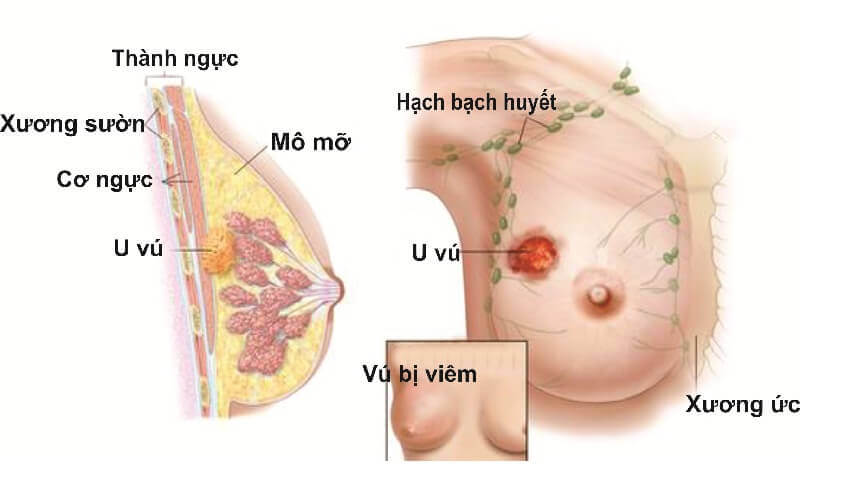 Cách điều trị viêm xơ tuyến sữa và những điều cần biết 34 Cách điều trị viêm xơ tuyến sữa và những điều cần biết 6