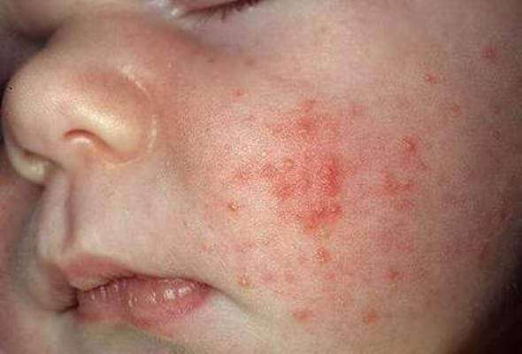 Cẩn trọng với bệnh viêm da cơ địa ở trẻ sơ sinh 34 bé bị viêm da