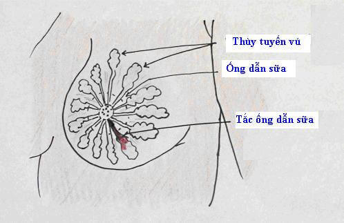 Đau đầu chuyện mẹ bị căng sữa nhưng sữa không tiết ra được 34 Đau đầu chuyện mẹ bị căng sữa nhưng sữa không tiết ra được 6
