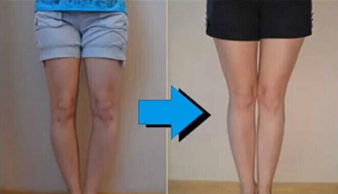 Điều trị chân vòng kiềng ở người lớn cần phải kiên trì 33 Điều trị chân vòng kiềng ở người lớn cần phải kiên trì 5