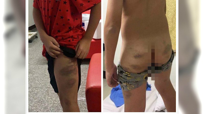 Đòn roi không bao giờ dạy trẻ thành người 34 trẻ bị đòn roi
