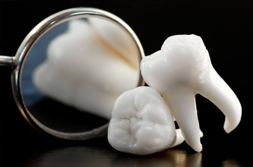 Giải đáp thắc mắc: Có nên nhổ răng khôn không? 33 Giải đáp thắc mắc: Có nên nhổ răng khôn không? 5
