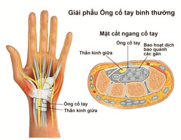 Hội chứng ống cổ tay là gì, cách điều trị ra sao? 7