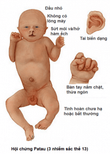 Hội chứng patau ở thai nhi và những điều mẹ cần biết 33 Hội chứng patau ở thai nhi và những điều mẹ cần biết 5