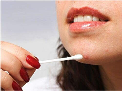 L&agrave;m g&igrave; sau khi nặn mụn 