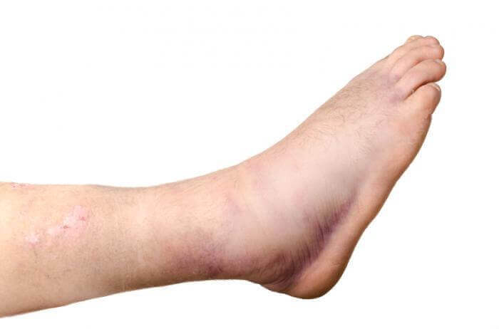 Mách mẹ cách chữa bong gân nhẹ ngay tại nhà 5