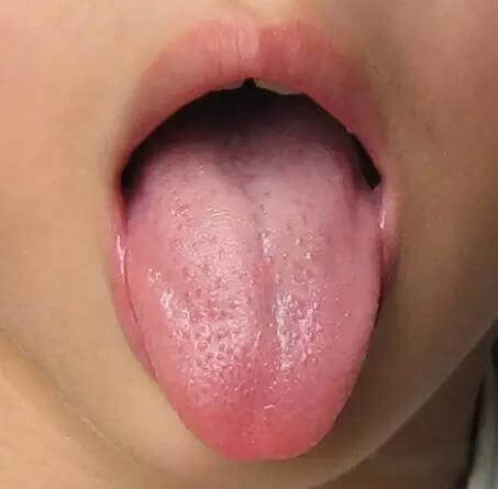 Mách mẹ cách nhìn lưỡi đoán bệnh trẻ cực chuẩn 37 Mách mẹ cách nhìn lưỡi đoán bệnh trẻ cực chuẩn 9