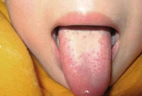 Mách mẹ cách nhìn lưỡi đoán bệnh trẻ cực chuẩn 40 Mách mẹ cách nhìn lưỡi đoán bệnh trẻ cực chuẩn 12
